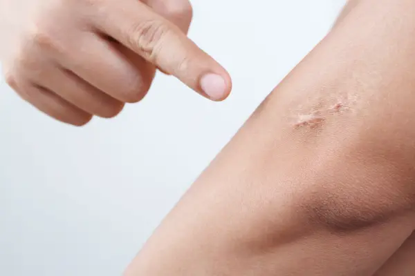 Scars Removal Treatment in Indore