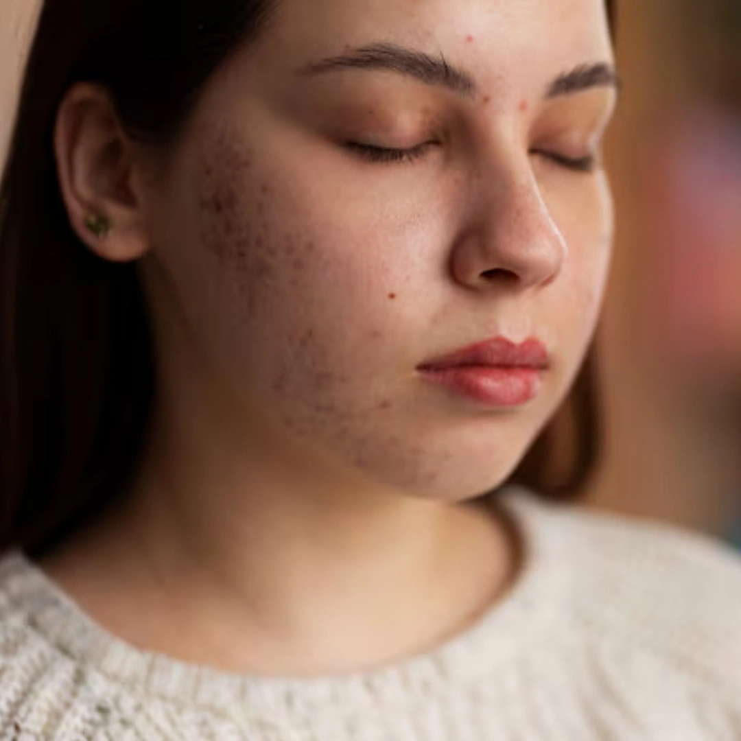 Dermatologist-Approved Methods to Get Rid of Facial Pigmentation