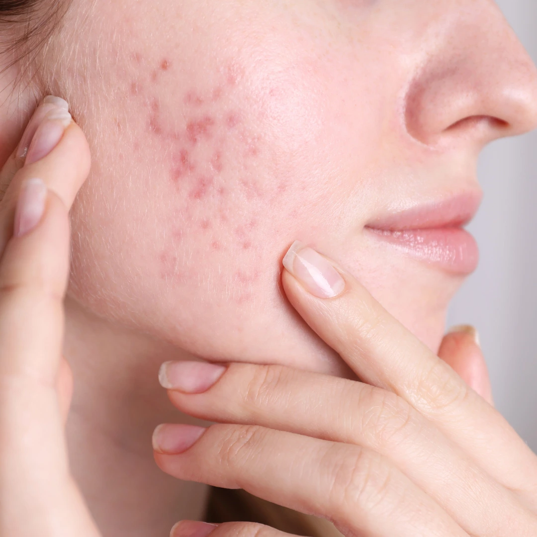 Acne Treatment in Indore