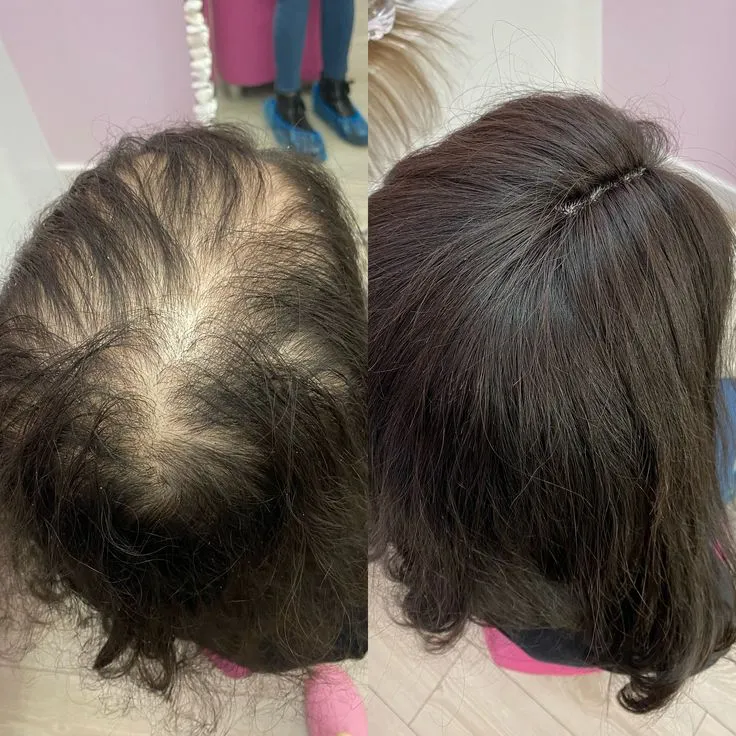 Female Hair Transplantation