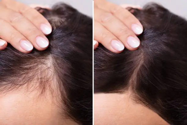 Body Hair Transplant