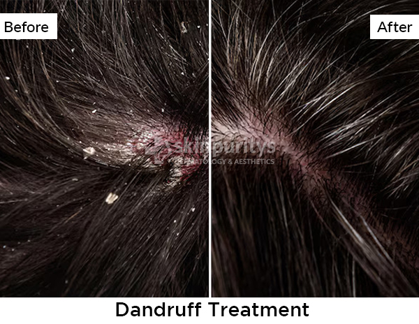 Dandruff results