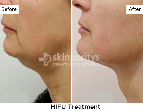 HIFU Treatment results