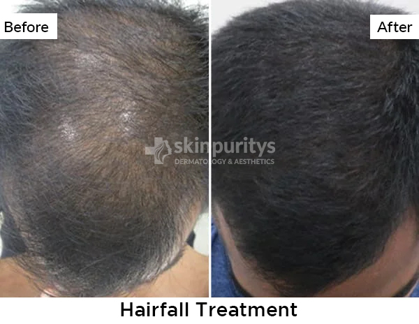 Hair Treatment Result - Before and After Photos