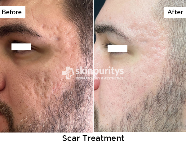 Scars results