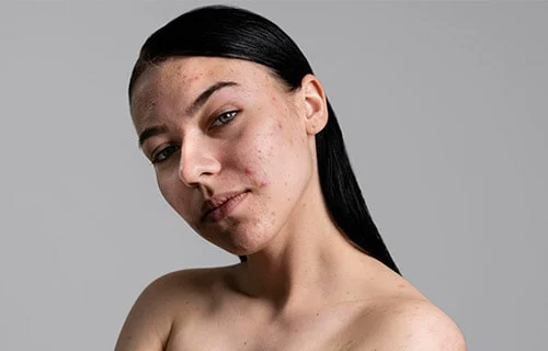 acne scar treatment in Indore