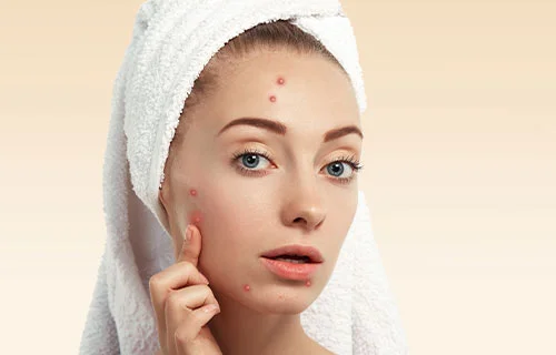 acne treatment in Indore