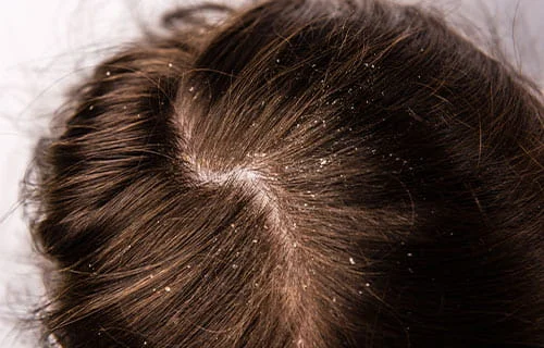 Dandruff Treatment in Indore