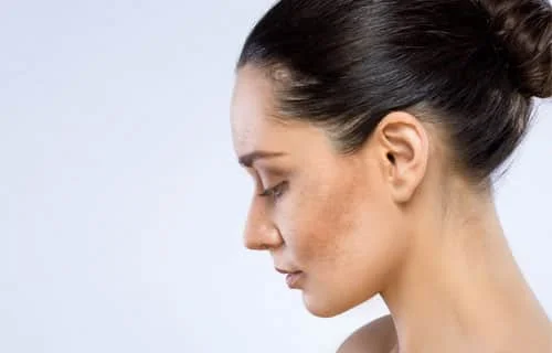 Melasma Treatment in Indore
