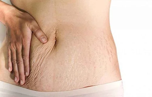 Stretch Marks Treatment in Indore