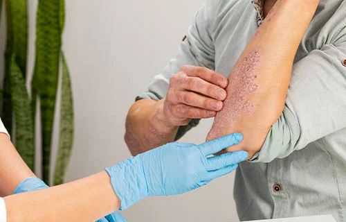Eczema Treatment in Indore