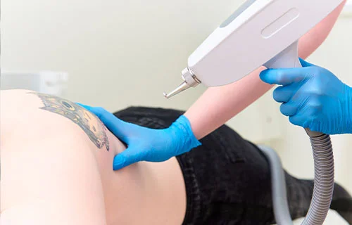 Laser Tattoo Removal Treatment in Indore