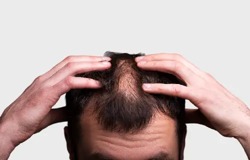 Alopecia Areata Treatment in Indore