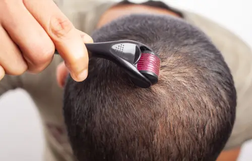 Derma roller Treatment in Indore