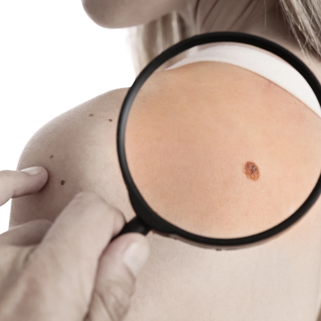 Best Skin Tag Removal Hyderabad