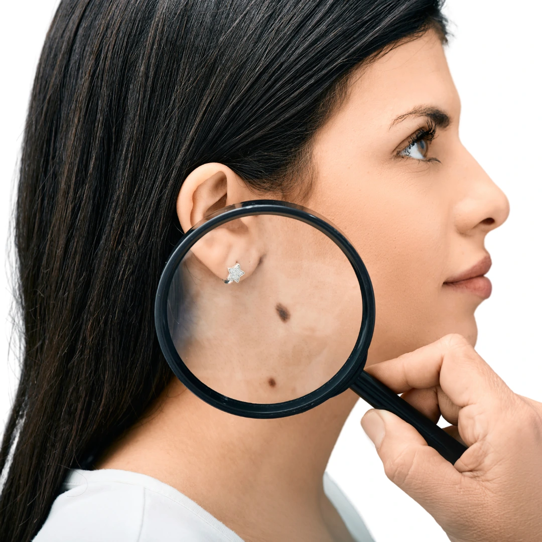 Best Clinic For Mole Removal in Hyderabad