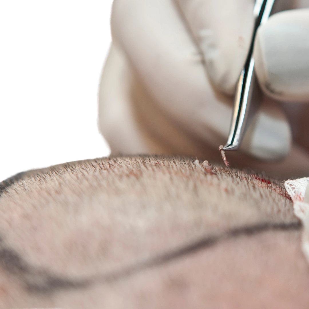 Best Hair Transplant