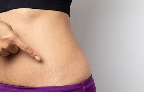 Stretch Marks